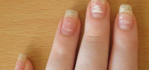 Белые пятна на ногтях