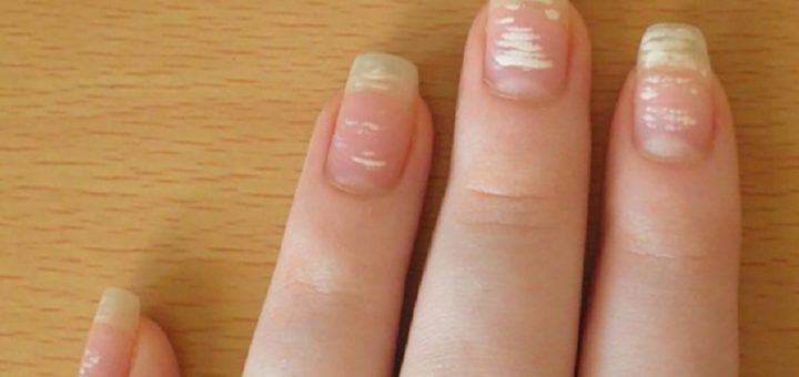 Белые пятна на ногтях